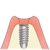 インプラント埋入