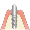 インプラントの頭を出す手術